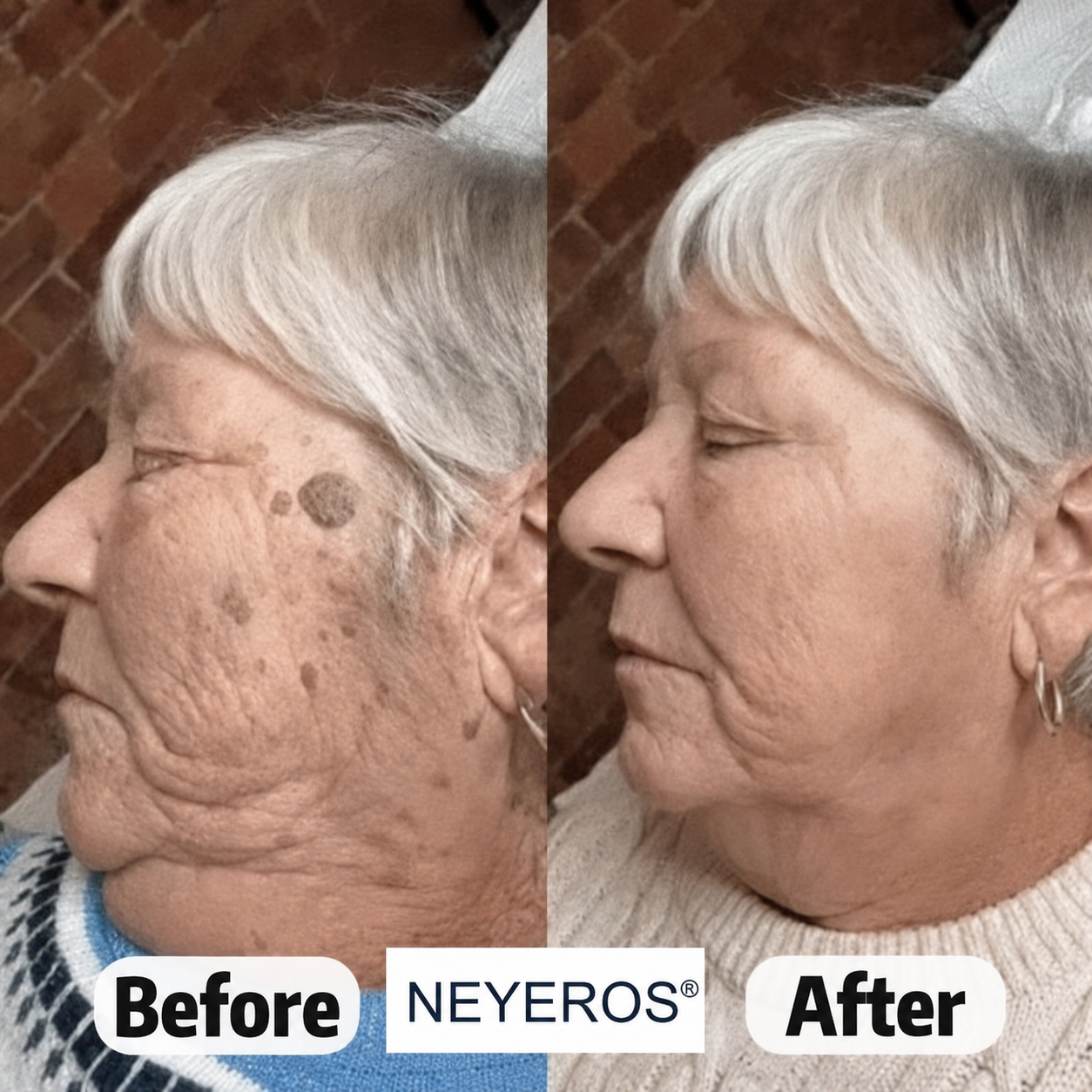 🏥👩‍⚕️NEYEROS®✨ 𝟕-𝐃𝒂𝘆 𝐒𝗸𝐢𝐧 𝐓𝒂𝗴 & 𝐒𝐩𝙤𝐭 𝐄𝐫𝒂𝐬𝙚𝐫 𝐏𝐚𝐢𝐧𝐥𝐞𝐬𝐬 & 𝐒𝐜𝐚𝐫-𝐅𝐫𝐞𝐞 𝐀𝐝𝐯𝐚𝐧𝐜𝐞𝐝 𝐈𝐦𝐩𝐞𝐫𝐟𝐞𝐜𝐭𝐢𝐨𝐧 𝐑𝐞𝐦𝐨𝐯𝐚𝐥 𝐑𝐨𝐥𝐥𝐞𝐫𝐛𝐚𝐥𝐥 𝐏𝐞𝐧