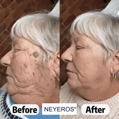 🏥👩‍⚕️NEYEROS®✨ 𝟕-𝐃𝒂𝘆 𝐒𝗸𝐢𝐧 𝐓𝒂𝗴 & 𝐒𝐩𝙤𝐭 𝐄𝐫𝒂𝐬𝙚𝐫 𝐏𝐚𝐢𝐧𝐥𝐞𝐬𝐬 & 𝐒𝐜𝐚𝐫-𝐅𝐫𝐞𝐞 𝐀𝐝𝐯𝐚𝐧𝐜𝐞𝐝 𝐈𝐦𝐩𝐞𝐫𝐟𝐞𝐜𝐭𝐢𝐨𝐧 𝐑𝐞𝐦𝐨𝐯𝐚𝐥 𝐑𝐨𝐥𝐥𝐞𝐫𝐛𝐚𝐥𝐥 𝐏𝐞𝐧